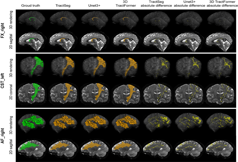 AC-UNet: Adaptive Connection UNet for White Matter Tract Segmentation Through Neural Architecture Search
