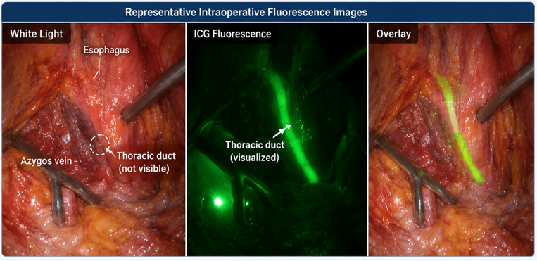 Real-Time Thoracic Duct Visualization in Lung Cancer Surgery: Feasibility of Indocyanine Green Fluorescence Imaging via Inguinal Lymph Node Injection