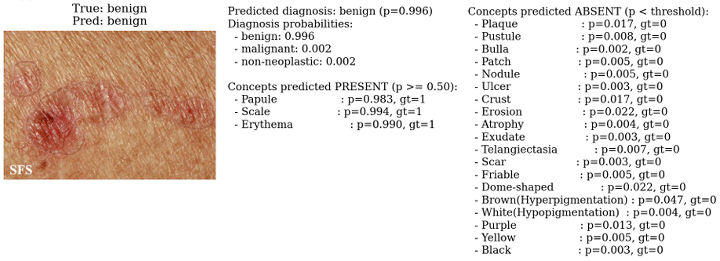 DCG-Net: Dual Cross-Attention with Concept-Value Graph Reasoning for Interpretable Medical Diagnosis