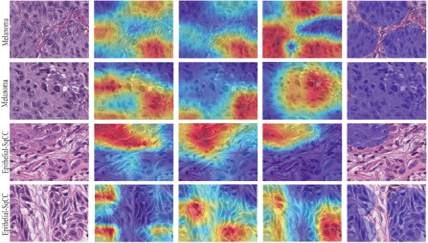 MDeiT: A lightweight and explainable hybrid model for cancer classification in histopathology images