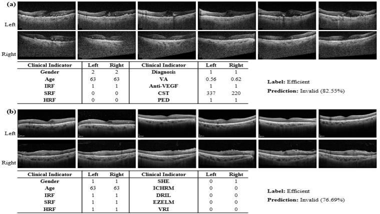 MVTT-GMamba: A Multimodal Graph Reasoning Framework for Anti-VEGF Efficacy Prediction in Diabetic Macular Edema